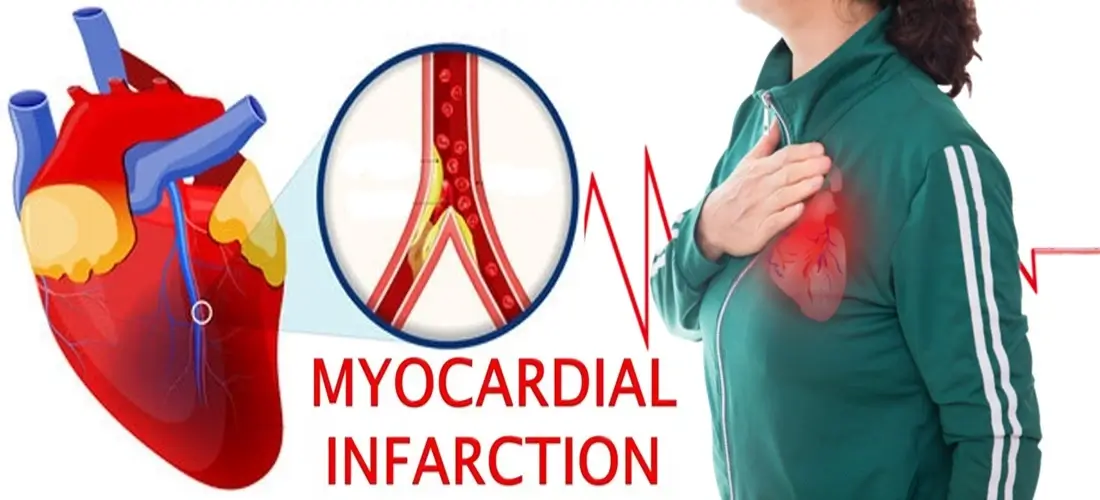 Heart on the Line: Understanding the Complexity of Myocardial Infarction