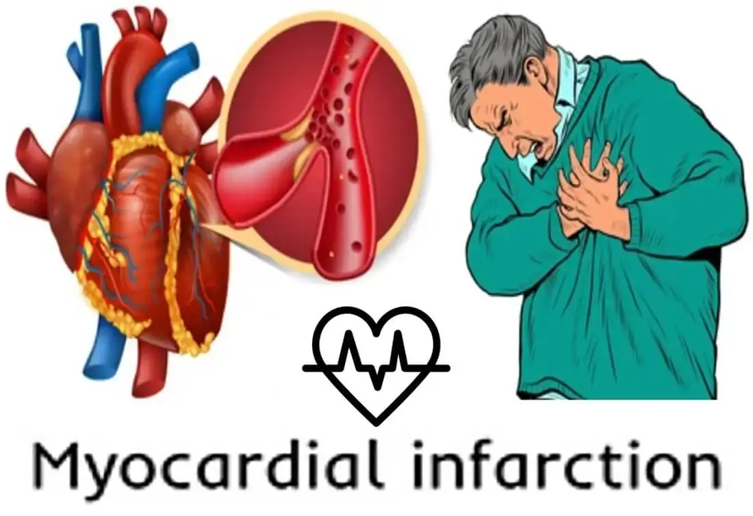 Myocardial Infarction