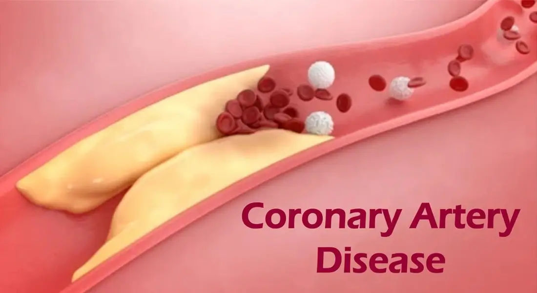 Coronary Artery Disease